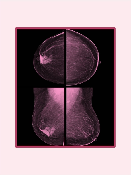 Breast Cancer - Background